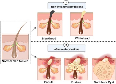 Acne Vulgaris A Review Of The Pathophysiology Treatment And Recent Nanotechnology Based Advances Sciencedirect