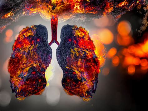 Understanding Bong Lung: Causes, Symptoms, and Effective Treatments
