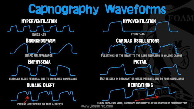 Capnography Readings in CHF: Debunking the Myth of Inaccuracy