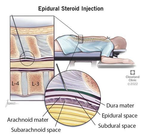 Effective Pain Relief: What You Need to Know About caudal epidural shot