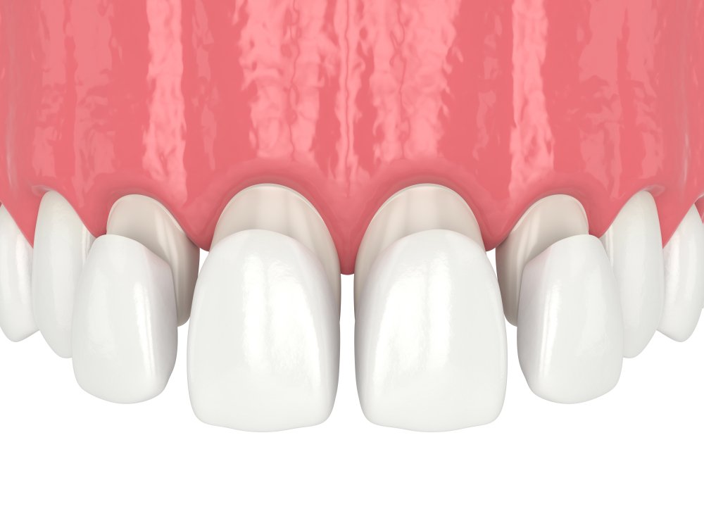 Composite Veneers A Comprehensive Guide To Your Perfect Smile