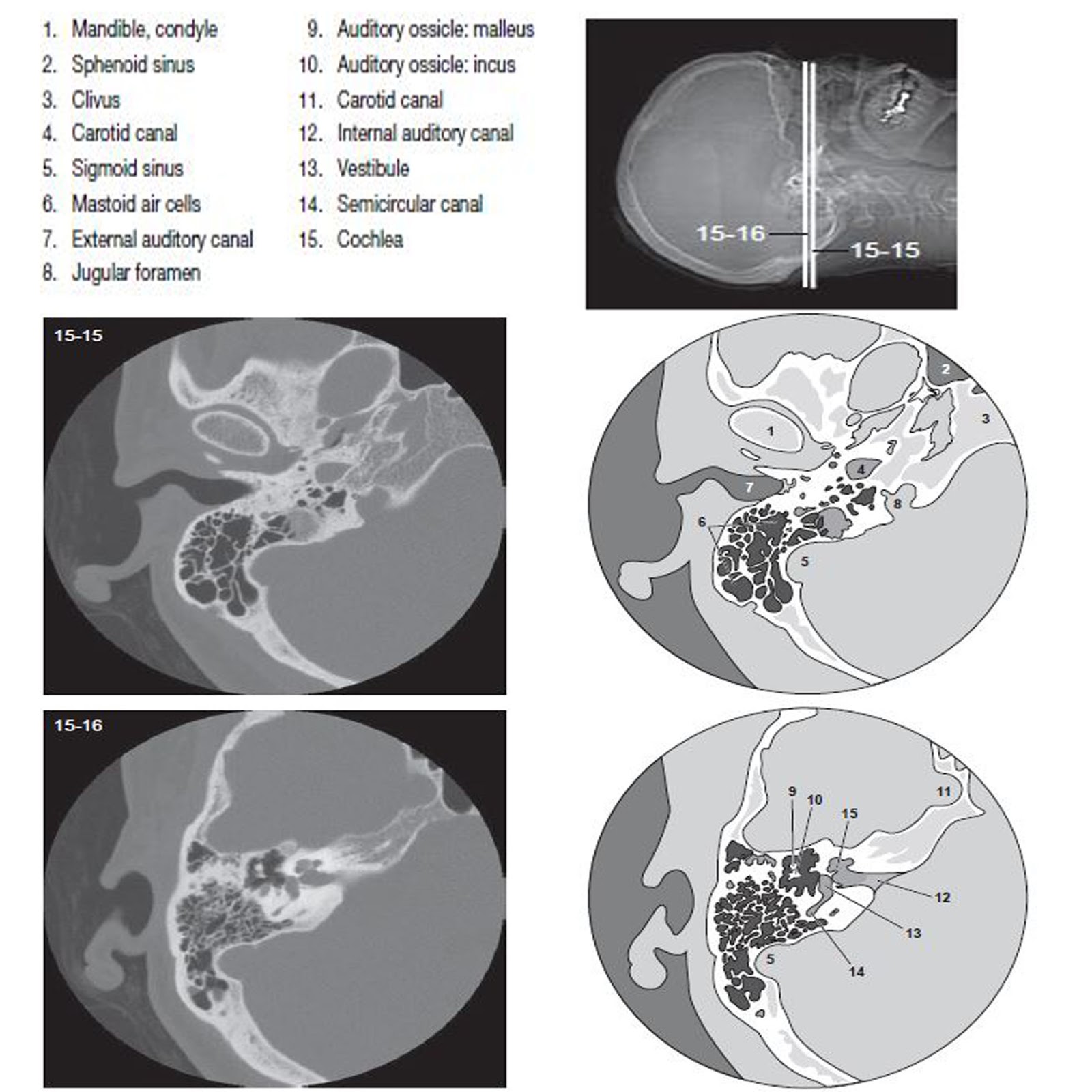 Unlocking Mysteries: The Fascinating World of the CT Temporal Bone