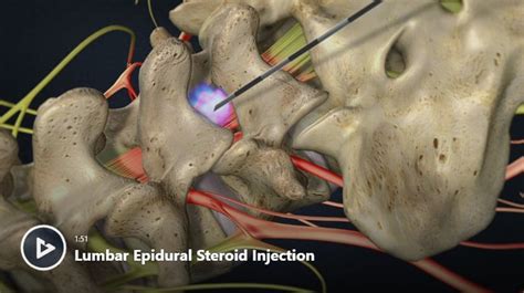 Epidural Steroid Injections In Orange County Ca Newport Orthopedic Institute