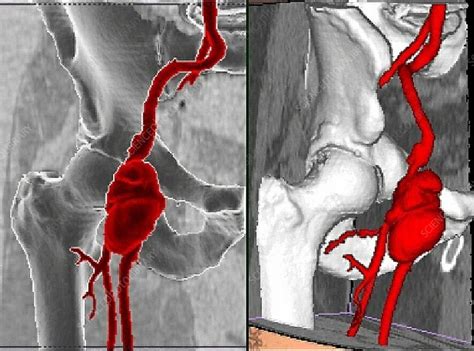 The Definitive Guide to Understanding and Managing Femoral Aneurysm