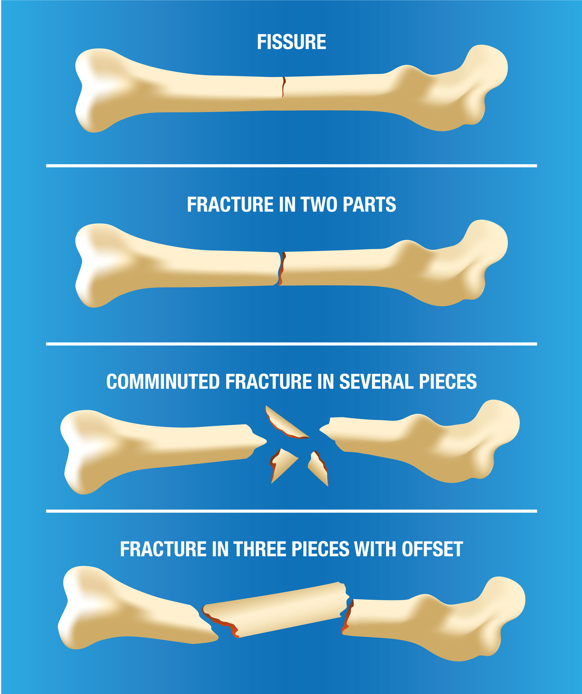 Mastering the Fracture Bedpan: A Clear Guide