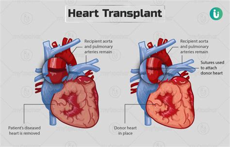 Understanding Heart Transplant Cost: Factors, Expenses, and Financial Planning