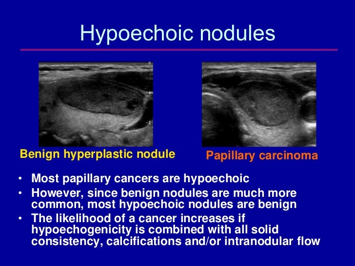 Understanding Hypoechoic Lesions: Diagnostic Insights and Imaging Features