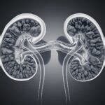 Beware of Common Mistakes When Using ICD 10 Nephrolithiasis Diagnoses