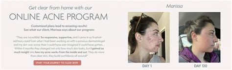 Natural Acne Clinic Award Winning In Person Online Acne Programs