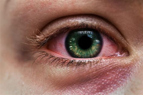Understanding Pink Eye Images: Causes, Symptoms, and Visual Insights