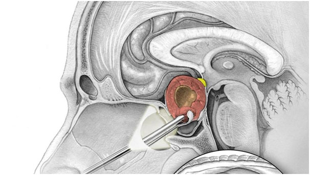 Pituitary Tumor Surgery