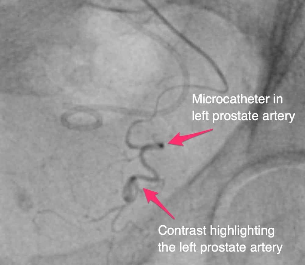What Are the Common Risks of Prostatic Artery Embolization?