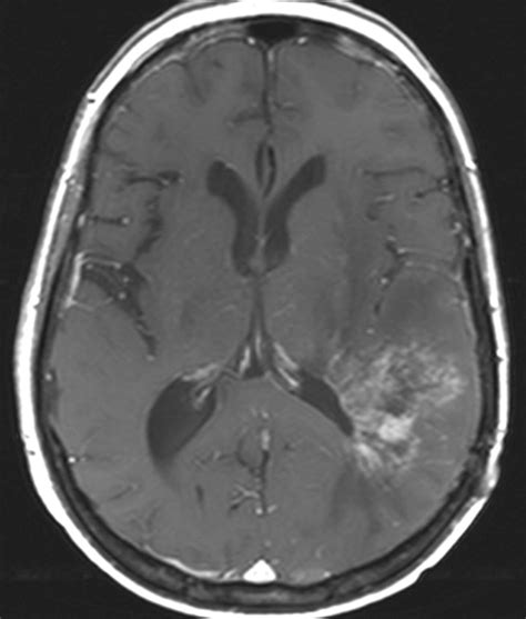 Understanding Radiation Necrosis: Symptoms, Causes, and Treatment Options