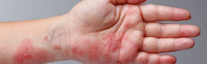 Symptoms Of Pink Eye Versant Health