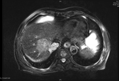 Understanding T2 Hyperintense Lesions: A Beginner's Guide
