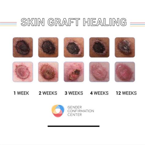 Top Surgery Nipple Grafts